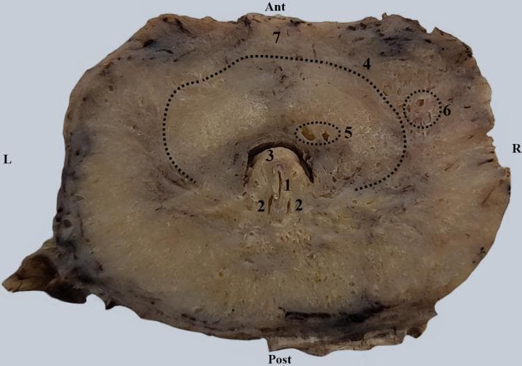 This clinical photograph displays a transverse anatomical section of a human prostate gland at the level of the seminal colliculus (verumontanum). Centrally, the prostatic urethra presents a characteristic semilunar shape with a posterior concavity. Key anatomical structures are labeled: the prostatic utricle (1) is positioned centrally on the seminal colliculus (3), flanked by the bilateral openings of the ejaculatory ducts (2). An arched dotted line (4) delineates the internal urethral sphincter (vesical sphincter), which serves as a structural boundary within the prostatic stroma. Small periurethral glands (5) are located medial to this muscular boundary, adjacent to the urethral lumen, while larger periurethral glands (6) are positioned lateral to the sphincter fibers. The anterior aspect shows the prostate isthmus (7). This section demonstrates the topographical relationship between the urinary and reproductive tracts within the male pelvic anatomy, highlighting the glandular distribution and the smooth muscle transition between the bladder neck and the prostatic urethra.