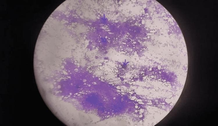 A low-magnification light micrograph of a human bone marrow aspirate, likely stained with a Romanowsky-type stain (e.g., Giemsa or Wright-Giemsa). The image shows hypercellular marrow fragments characterized by dense, purple-stained hematopoietic cellular clusters interspersed with clear, round vacuoles representing adipose tissue (marrow fat). Within these hypercellular areas, there is evidence of megakaryocytic hyperplasia (marked megakaryocytosis). Prominent, large basophilic cells representing megakaryocytes are visible, some of which are indicated by dark blue arrows. The surrounding stroma appears mottled with varying cellular density. This diagnostic image demonstrates the hematological manifestations often associated with POEMS syndrome, specifically the proliferation of the megakaryocytic lineage within the marrow compartment.