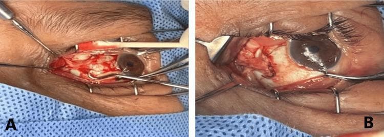 Two side-by-side intraoperative clinical photographs (A and B) demonstrating a medial rectus (MR) muscle resection on a left eye, a procedure typically used in ophthalmic surgery to correct strabismus or muscle palsy. Panel A shows the initial surgical exposure with the medial rectus muscle identified; the muscle appears notably thin and atrophic, a pathological state following a previous orbital injury or hematoma. The surgical field is maintained using eyelid speculums and muscle hooks, with moderate focal hemorrhage visible on the scleral surface. Panel B depicts the same anatomical region after a 6 mm resection of the MR muscle has been performed. In this view, the muscle is shortened and repositioned, appearing relatively thicker and more compact compared to the pre-resection state. Suture material is visible where the muscle has been reattached to the sclera. These images illustrate the surgical management of muscular atrophy to restore binocular alignment (orthophoria) and resolve diplopia.