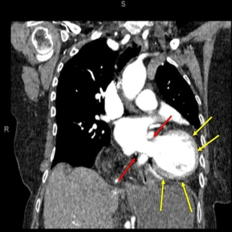 This diagnostic image is a coronal view of a Computed Tomography (CT) scan of the chest and upper abdomen, demonstrating a complex gastric volvulus associated with a large paraesophageal hiatus hernia. Red arrows indicate the rolling paraesophageal hiatus hernia, where a portion of the stomach has herniated through the esophageal hiatus into the thoracic cavity. The stomach exhibits significant distension and abnormal rotation (volvulus), leading to a distortion of normal gastrointestinal anatomy. Yellow arrows point to visible fluid accumulation (perigastric fluid) surrounding the gastric component within the intra-abdominal and lower thoracic space, which may suggest inflammation or venous congestion. The CT scan highlights the relationship between the anatomical displacement of the stomach and the potential for obstructive pathology. This material serves as a clinical reference for identifying surgical emergencies involving the upper gastrointestinal tract, specifically the coexistence of hiatal herniation and organoaxial or mesenteroaxial twisting of the stomach.