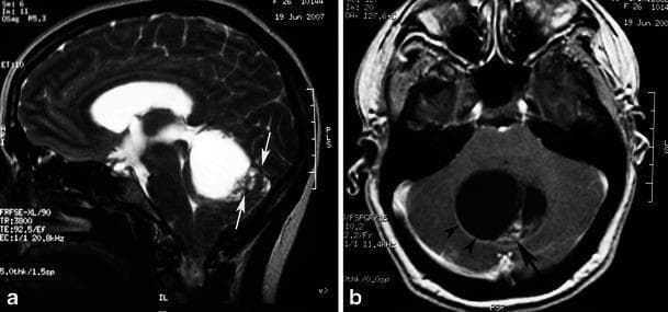 This diagnostic image set consists of two MRI scans demonstrating a pilocytic astrocytoma in the posterior fossa of a 26-year-old female. Image (a) is a sagittal T2-weighted MRI showing a large, well-circumscribed, hyperintense cystic mass located in the cerebellar vermis. A distinct, peripherally situated mural nodule (indicated by arrows) is visible on the posterior aspect of the cyst, which is causing significant mass effect and compression of the fourth ventricle. Image (b) is an axial contrast-enhanced T1-weighted MRI at the level of the cerebellum. It demonstrates the classic enhancement pattern of this pathology: the mural nodule (arrow) shows intense, homogeneous contrast uptake, and there is also smooth enhancement along the cyst wall (arrowheads). These features are hallmark diagnostic criteria for a WHO Grade I pilocytic astrocytoma. The clinical significance of these images lies in demonstrating the relationship between the cystic component, the enhancing solid nodule, and the resultant obstructive pressure on adjacent ventricular structures.