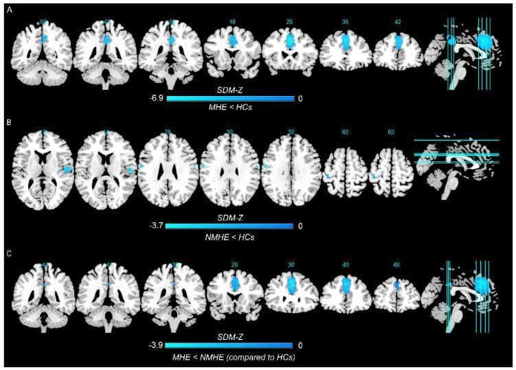 This diagnostic image displays three rows (A, B, C) of axial and sagittal brain fMRI maps illustrating altered spontaneous brain activity in patients with hepatic encephalopathy. The visualization utilizes seed-based d mapping (SDM-Z) scores. Row A compares patients with minimal hepatic encephalopathy (MHE) to healthy controls (HCs), showing significant clusters of decreased activity (represented by cold blue colors) in the left superior frontal gyrus and median cingulate gyri. Row B compares non-MHE cirrhotic patients (NMHE) to HCs, highlighting more localized decreases in activity within the fronto-parietal regions, including the right rolandic operculum and bilateral postcentral gyrus. Row C displays a conjunction analysis between MHE and NMHE patients relative to HCs, emphasizing the progression of neurological impairment. Each row includes multiple axial slices with specific MNI coordinates and a corresponding sagittal reference view indicating slice orientation. These findings serve as neuroimaging biomarkers for detecting and differentiating stages of hepatic encephalopathy in clinical neurology and hepatology.