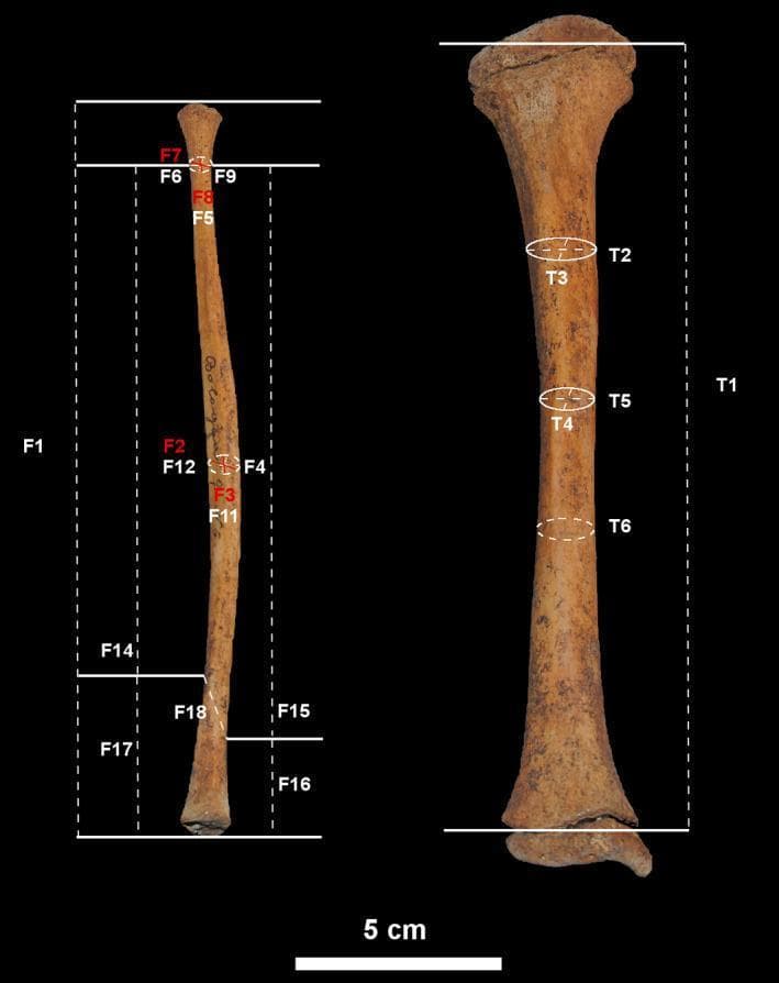 This clinical imaging figure displays human subadult skeletal remains of the right tibia and fibula, positioned vertically against a black background for osteometric analysis. The image serves as an anatomical and anthropological guide for bone measurement. The tibia on the right shows a broad proximal end with developing condylar morphology and a distal end exhibiting post-mortem damage. Labeled measurements (T1–T6) indicate longitudinal length and cross-sectional diameters at the proximal, midshaft, and distal thirds. The fibula on the left is slender and elongated, with labels (F1–F18) marking anthropometric points including the fibular neck, midshaft circumference, and the distal malleolar region. Dotted lines and arrows illustrate the specific planes for metric assessment. A 5 cm scale bar is provided at the bottom. This visual is designed for orthopedic research, forensic anthropology, and pediatric osteology to study growth patterns and developmental changes in the lower limb bones of children.