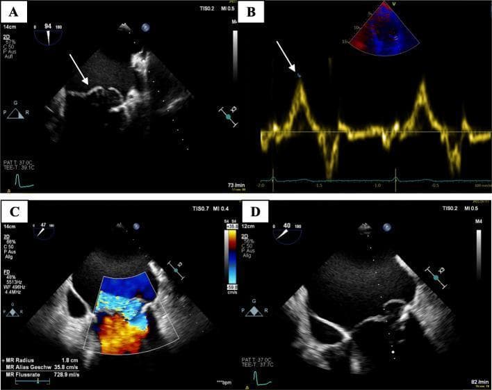 This composite of four transesophageal echocardiography (TEE) images illustrates the diagnostic findings of myxomatous mitral valve disease and its hemodynamic consequences. Panel A (2D TEE) demonstrates a classic bileaflet mitral valve prolapse (MVP), with the leaflets bulging superiorly into a significantly dilated left atrium (LA) during systole. Panel B utilizes Tissue Doppler Imaging (TDI) at the lateral annulus to show a high-velocity mid-systolic spike (Pickelhaube sign) reaching 18 cm/s, which is a characteristic marker associated with arrhythmogenic MVP. Panel C employs color Doppler flow mapping to visualize a severe, eccentric mitral regurgitation (MR) jet. The mosaic color pattern indicates high-velocity, turbulent retrograde flow into the LA, with quantitative metrics showing an MR radius of 1.8 cm and a flow rate of 728.9 ml/s. Panel D shows a detailed 2D view of the myxomatous degeneration, characterized by marked thickening and redundant tissue of the mitral leaflets. This collection is intended for cardiology education, highlighting the integration of anatomical 2D imaging with advanced Doppler techniques to assess valvular pathology and associated arrhythmic risk.
