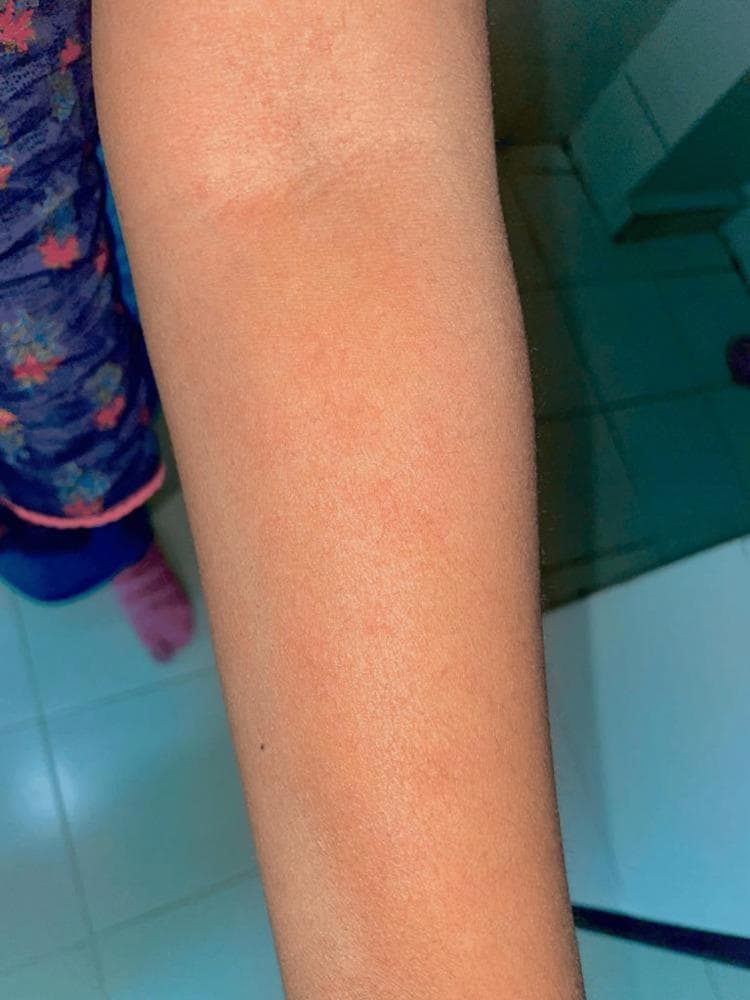 This clinical photograph displays a close-up view of a human upper extremity, specifically the forearm and elbow region, exhibiting a diffuse dermatological reaction. The skin presents with a generalized erythematous (reddish) hue and is covered by an extensive, confluent rash. Visible features include numerous small, raised, erythematous papules and classic wheals characteristic of urticaria (hives). The distribution is widespread across the limb, with a notable concentration of skin inflammation and swelling around the antecubital fossa (inner elbow). This presentation is clinically significant as it illustrates a hypersensitivity reaction or angioedema-like presentation, which in this medical context is associated with an adverse drug reaction following olanzapine administration. The image serves as an educational tool for identifying medication-induced cutaneous manifestations and acute allergic skin responses in clinical practice.