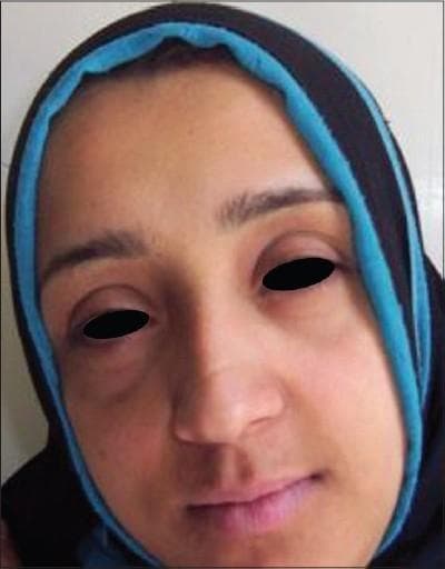 Clinical photograph of a patient's face, specifically highlighting the periocular region. The image illustrates mild-to-moderate periocular hyperpigmentation, commonly referred to as dark circles or infraorbital hyperchromia. The discoloration is most prominent along the inferior orbital rim and lower eyelids, with a higher intensity of faint brownish pigmentation noted at the medial canthi. The skin texture appears relatively smooth, with the primary finding being the focal increase in melanin or vascular congestion in the periorbital tissues. This image serves as a post-treatment documentation frame, showing a satisfactory clinical response where the transverse and vertical dimensions of the hyperpigmentation have reduced. In an educational context, this visual demonstrates the clinical manifestation of periocular darkening which can be associated with external factors like kohl application or systemic issues like lead toxicity, and is used to evaluate the efficacy of dermatological or chelation interventions.
