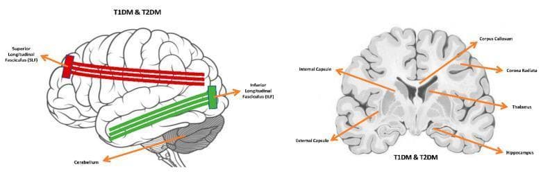 This medical illustration consists of two diagrams identifying brain regions frequently associated with microstructural tissue alterations in patients with Type 1 (T1DM) and Type 2 (T2DM) diabetes mellitus. The left diagram shows a lateral view of the human brain, highlighting two major white matter tracts: the Superior Longitudinal Fasciculus (SLF) in red and the Inferior Longitudinal Fasciculus (ILF) in green, with an orange arrow indicating the Cerebellum. The right diagram provides a coronal section of the brain with orange arrows labeling several key internal structures: the Corpus Callosum (superior midline), Corona Radiata, Thalamus (deep gray matter), Hippocampus (medial temporal lobe), and the Internal and External Capsules (white matter pathways). The diagrams serve an educational purpose by mapping common neuroanatomical sites of diabetic impact on brain integrity, relevant for clinical neurology and radiology students studying the long-term metabolic complications of diabetes on the central nervous system.