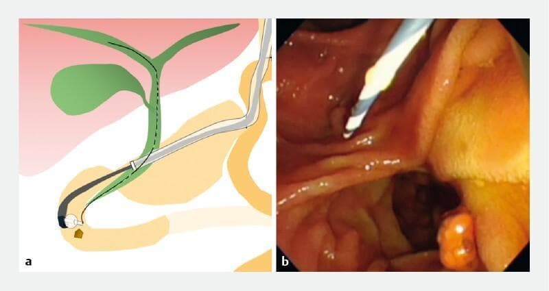 This figure demonstrates an endoscopic retrograde cholangiopancreatography (ERCP) procedure in a patient with surgically altered gastrointestinal anatomy. Panel A is an anatomical diagram illustrating the use of a large-diameter sliding tube to navigate through a tortuous gastrojejunal anastomosis. The schematic shows a side-viewing endoscope extending through the sliding tube into the duodenum to access the biliary tree. The biliary system is depicted in green, showing the gallbladder and the common bile duct, with a small brown stone located at the distal end of the duct. Panel B is a clinical photograph representing an endoscopic view during the procedure. It shows the reddish-orange, moist mucosal lining of the gastrointestinal tract. A white tubular endoscopic instrument is visible within the lumen, positioned near a possible anatomical landmark or small polypoid lesion on the right. The image illustrates a technique for overcoming difficult endoscopic access in post-gastrectomy patients to perform therapeutic interventions such as common bile duct stone removal.