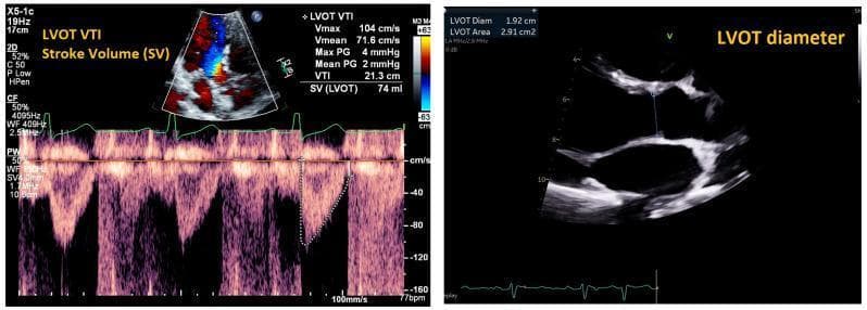This dual-panel diagnostic image demonstrates the echocardiographic method for non-invasively estimating cardiac output (CO) by calculating stroke volume (SV). The left panel displays a pulsed-wave Doppler echocardiogram in the apical four-chamber view. It features a color Doppler inset and a spectral Doppler tracing used to measure the Left Ventricular Outflow Tract Velocity Time Integral (LVOT VTI). Clinical data shown include a VTI of 21.3 cm and a calculated stroke volume of 74 ml. The right panel shows a 2D grayscale echocardiogram in the parasternal long-axis view, used to measure the LVOT diameter (1.92 cm) and area (2.91 cm²) during systole. Together, these views provide the necessary parameters—LVOT area and VTI—to determine hemodynamic status. Key educational concepts include the application of the continuity equation and Doppler hemodynamics in assessing heart failure and volume status.