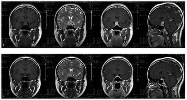 This diagnostic image set consists of brain MRI scans in coronal and sagittal planes, comparing the pituitary region before (A) and after (B) thyroxine treatment for primary hypothyroidism. Row A (Pre-treatment) displays a markedly enlarged, hyperintense pituitary gland (compensatory pituitary hyperplasia) within the sella turcica. The enlarged gland demonstrates upward expansion, resulting in displacement and compression of the optic chiasm and pituitary stalk. Row B (Post-treatment) shows the same anatomical regions after hormone replacement therapy, illustrating a significant reduction in pituitary volume. The gland has returned to a near-normal size and configuration, with restoration of the suprasellar cistern and relief of compression on the optic chiasm. This comparison illustrates the reversible nature of pituitary hypertrophy secondary to untreated primary hypothyroidism, where lack of negative feedback by thyroid hormones leads to TSH-secreting cell hyperplasia. The imaging supports a diagnosis of reactive pituitary enlargement rather than a primary adenoma.
