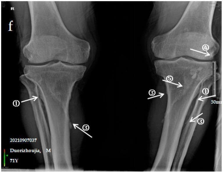 This diagnostic image is an anteroposterior (AP) X-ray of both lower limbs, specifically focusing on the knee joints and proximal shafts of the tibiae and fibulae. The radiograph illustrates severe manifestations of Skeletal Fluorosis (SF), characterized by extensive ectopic ossification. Label ① points to dense, irregular ossification of the tibiofibular interosseous membrane, exhibiting a characteristic 'colliculus' or nodular appearance between the bones. Label ③ highlights multiple 'ossification shadows' or opaque bony outgrowths along the shafts of the tibia and fibula. Label ④ identifies significant ossification of the knee joint capsule on the right limb, appearing as a radiopaque mass near the joint line. Label ⑤ indicates ossification of the soleus tendon, visible as a distinct bony density posterior to the proximal tibia. These findings represent advanced skeletal changes including periosteal new bone formation and ligamentous/tendinous calcification, relevant for diagnosing and staging chronic fluoride toxicity in clinical radiology.