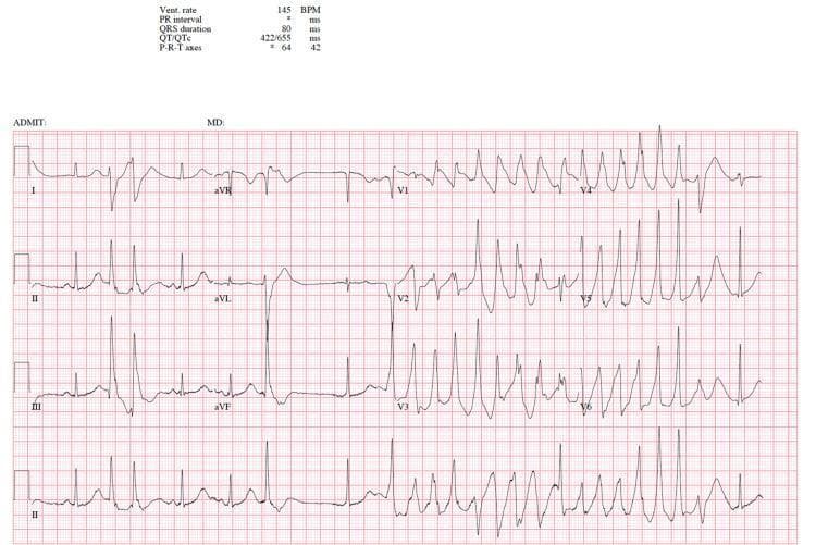 A 12-lead electrocardiogram (ECG/EKG) demonstrating a polymorphic ventricular tachycardia known as Torsades de Pointes. The tracing shows rapid, irregular, wide-complex QRS morphology characterized by a distinctive 'twisting' or undulating pattern of the QRS peaks around the isoelectric baseline. The amplitude of the QRS complexes continuously waxes and wanes, creating a spindle-like appearance. Quantitative data at the top left indicates a ventricular rate of 145 BPM and a significantly prolonged corrected QT interval (QTc) of 655 ms, which is a critical precursor to this specific arrhythmia. The precordial leads (V1-V6) clearly display the bizarre morphology and large, shifting T-waves associated with the tachyarrhythmia. This diagnostic image illustrates a life-threatening cardiac event often triggered by electrolyte imbalances or QT-prolonging medications in susceptible individuals, serving as an educational example of malignant ventricular rhythms.