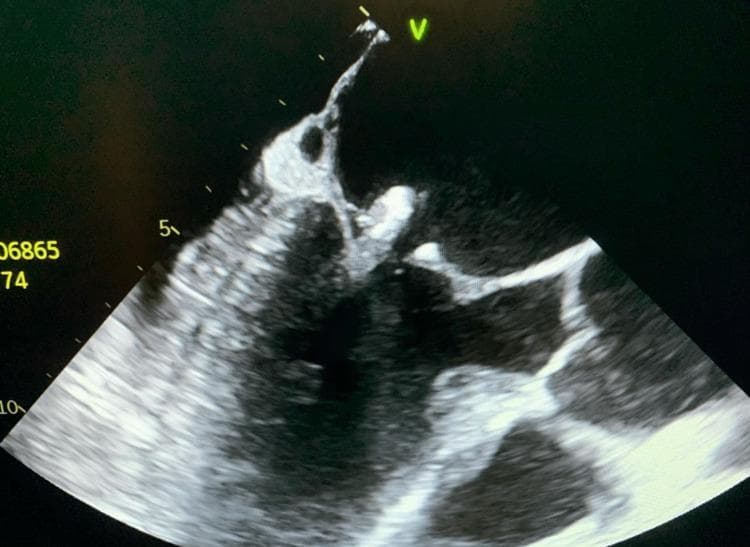 This diagnostic image is a transesophageal echocardiogram (TEE) demonstrating infective endocarditis of the mitral valve. The ultrasound shows a large, pedunculated, and irregularly shaped echogenic mass (vegetation) attached to the posterior mitral valve leaflet. The vegetation appears mobile, extending significantly into the heart chamber. The underlying mitral valve leaflets exhibit areas of increased echogenicity and thickening, consistent with valvular calcification and chronic degenerative changes, which may serve as a nidus for reinfection. This finding is clinically significant for the diagnosis of bacterial endocarditis, often necessitated when transthoracic echocardiography (TTE) is inconclusive. The image highlights the critical role of TEE in visualizing valvular vegetations, assessing their size (approximately 1.3 cm in this case), and identifying comorbid conditions like valve calcification in patients with positive blood cultures or suspected cardiac source of emboli.