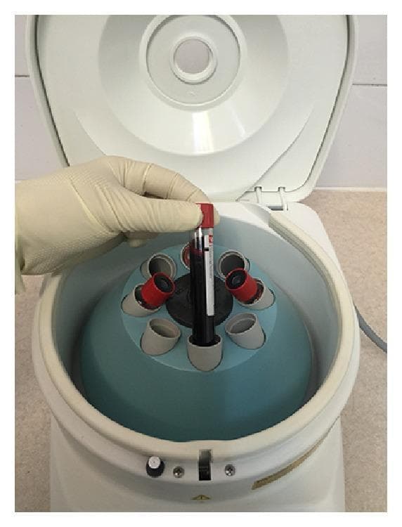 This clinical photograph displays the initial stage of blood processing for autologous platelet concentrates, specifically Platelet-Rich Fibrin (PRF) or Plasma Rich in Growth Factors (PRGF). A gloved hand is shown inserting a vacuum-sealed blood collection tube (Vacutainer style) into a medical centrifuge. The tube contains whole human blood and features a red stopper, typically indicating a serum tube or one without anticoagulants depending on the specific protocol (e.g., L-PRF). The centrifuge is a benchtop model with an open lid, revealing a blue fixed-angle rotor with eight bucket positions designed for standard 5ml or 10ml tubes. The image illustrates a critical laboratory step in regenerative medicine where controlled centrifugation parameters (e.g., 400g) are used to separate blood components—red blood cells, white blood cells, and plasma—to create a fibrin clot or plasma rich in growth factors for clinical applications such as wound healing or tissue engineering.