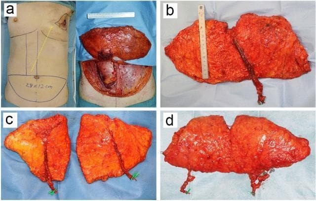 This composite clinical photograph illustrates the evolution of abdominal autologous flaps for breast reconstruction, classified by surgical technique and vascular anatomy. (a) Displays a pedicled Transverse Rectus Abdominis Myocutaneous (TRAM) flap; the left panel shows preoperative markings on the torso with a subcutaneous tunnel path (yellow arrow), while the right panel shows the harvested musculocutaneous tissue. (b) Demonstrates a Deep Inferior Epigastric Artery Perforator (DIEP) flap, characterized by the preservation of the rectus abdominis muscle; the vascular pedicle is dissected and clearly visible against the harvested adipose tissue. (c) Shows a DIEP flap divided into two distinct units for bilateral breast reconstruction, each with its own preserved vascular pedicle. (d) Illustrates a Superficial Inferior Epigastric Artery (SIEA) flap, which utilizes the superficial vascular system and avoids fascia or muscle incision. Across all images, the flaps primarily consist of cutaneous and subcutaneous adipose tissue. These photographs provide educational value for plastic surgery training by demonstrating variations in flap harvest, vascular pedicle management, and tissue composition required for different reconstructive strategies.