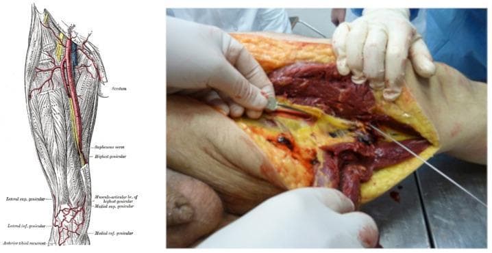 This dual-panel image provides a comparison between normal anatomy and traumatic vascular pathology of the lower limb. The left panel is a classical anatomical diagram of the right thigh, illustrating the femoral artery, its major branches, and associated nerves such as the saphenous nerve and genicular arteries. The right panel is a clinical photograph from a forensic or surgical setting showing a deep, penetrating injury to the left medial thigh. The photograph demonstrates a large, gaping wound with clear stratification of tissues: the pale yellow subcutaneous adipose tissue, the dark red skeletal muscle fibers of the adductor or quadriceps groups, and a centrally located, severed femoral artery. A metal surgical probe or instrument is inserted to demonstrate the depth of the track and the complete transection of the vascular bundle. Hemorrhagic staining and tissue maceration are visible throughout the wound bed. This image serves as an educational tool for identifying vascular trauma and understanding the surgical and forensic anatomy of femoral artery injuries resulting from high-energy mechanisms, such as gunshot wounds or sharp force trauma.