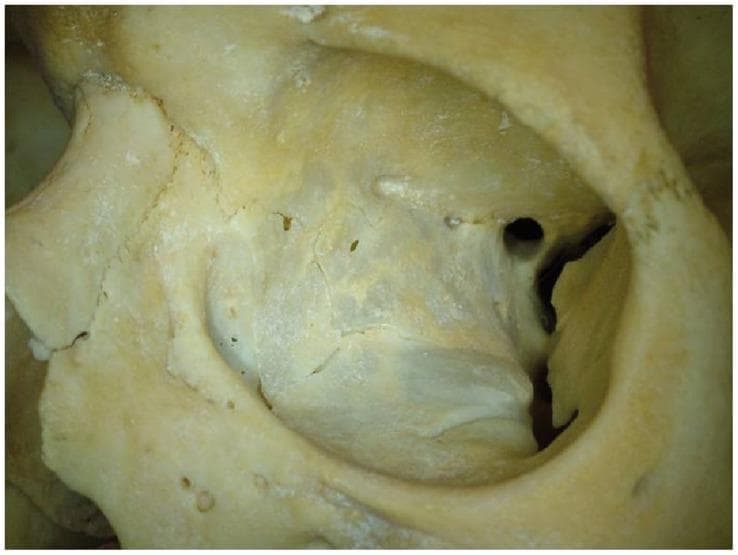 This clinical photograph displays a close-up, anterolateral view of a human bony orbital cavity, likely from a dry skull specimen. The image provides a detailed anatomical view of the internal surfaces and apertures of the orbit. Centrally located at the posterior aspect is the optic canal, appearing as a rounded foramen. Adjacent to it, the superior orbital fissure is visible as an elongated, narrow cleft between the greater and lesser wings of the sphenoid bone. The bony wallsβcomprising the frontal, zygomatic, and sphenoid bonesβexhibit a characteristic pale yellowish-white color with varied textures, including smooth articular areas and roughened sites for muscular and ligamentous attachments. Visible sutures and several smaller accessory foramina (such as ethmoidal foramina) are present along the medial wall and floor. This visual material is used in medical education to demonstrate normal cranial osteology, orbital volume analysis, and the structural relationship between cranial nerves and the orbital apex.