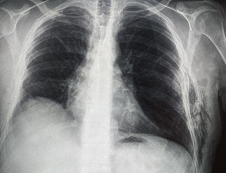 This diagnostic image is an anteroposterior (AP) chest X-ray demonstrating parietal subcutaneous gas and signs of underlying pulmonary pathology. The most prominent finding is the presence of subcutaneous emphysema along the left lower chest wall and axillary region, appearing as linear and mottled radiolucencies (dark streaks) dissecting through the soft tissue planes. Both lung fields exhibit hyperlucency and flattened diaphragms, characteristic of hyperinflation consistent with chronic obstructive pulmonary disease (COPD) or emphysema. The right lung appears more hyperlucent than the left. Bony structures, including the ribs, clavicles, and scapulae, are clearly visualized, with the ribs showing a more horizontal orientation typical of hyperinflation. The mediastinum remains centrally located. This radiograph is an educational example of subcutaneous emphysema resulting from thoracic wall air leakage, often seen in the context of pulmonary hernias or previous thoracic surgeries.
