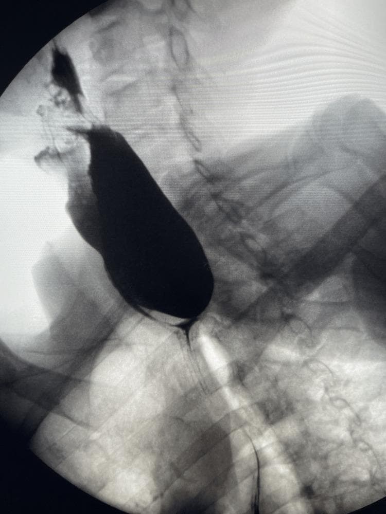 This lateral barium swallow radiograph (contrast esophagram) of the cervical and upper thoracic region demonstrates a large Zenker's diverticulum. A significant, well-defined, radiopaque, sac-like outpouching is visible originating from the posterior wall of the pharyngoesophageal junction, specifically at Killian's dehiscence above the cricopharyngeal muscle. The diverticulum is filled with barium contrast, appearing as an elongated, dependent sac approximately 7 cm in length that displaces the esophagus anteriorly. There is a clear narrowing or 'neck' at the proximal connection point where the diverticulum communicates with the esophageal lumen. The image highlights significant barium retention within the pouch, a hallmark finding of this false diverticulum. This diagnostic image is intended for medical education regarding upper gastrointestinal pathologies, specifically pharyngeal pouch disorders and causes of cervical dysphagia and regurgitation.
