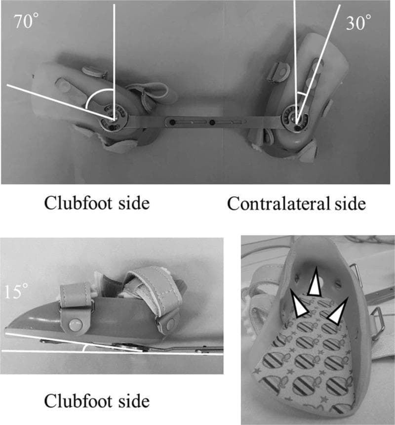This composite clinical photograph illustrates a Foot Abduction Brace (FAB) used in the Ponseti method for treating idiopathic clubfoot. The top panel shows a superior view of the brace, consisting of two molded shoe inserts connected by a Denis Browne bar. The affected 'clubfoot' side is set at 70 degrees of external rotation, while the unaffected 'contralateral' side is set at 30 degrees. The bottom-left panel provides a lateral view of the clubfoot insert, highlighting a 15-degree dorsiflexion angle. The bottom-right panel displays the interior of a shoe insert, where arrowheads indicate molded thermoplastic ethylene-vinyl acetate (EVA) integrated into the heel section to prevent hindfoot slippage. The inserts feature adjustable straps with buckles for secure fixation and a padded, patterned interior for patient comfort. This medical device is designed to maintain the corrected position of the foot following serial casting or tenotomy, preventing relapse by maintaining specific abduction and dorsiflexion angles during growth.