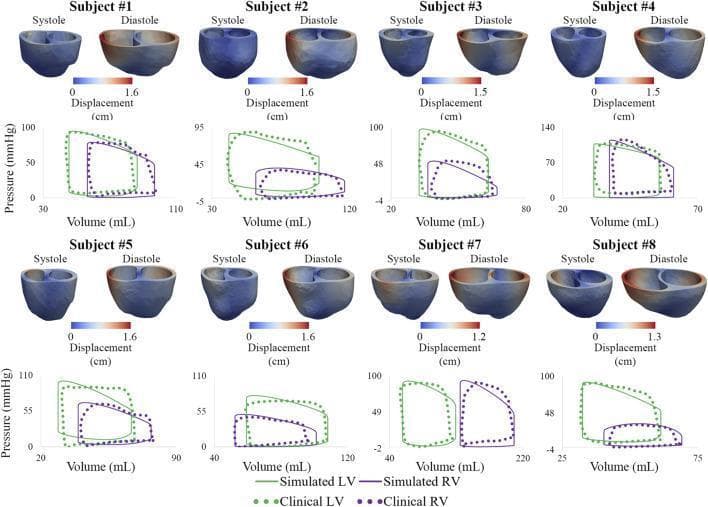 This medical graphic presents a multi-subject comparative study (8 subjects) of cardiovascular mechanics, combining biventricular displacement maps and pressure-volume (PV) loops. The top portion of each subject panel shows 3D color-coded ventricular models during end-systole and end-diastole. Displacement is mapped on a scale from 0 cm (blue) to approximately 1.2–1.6 cm (red), illustrating wall motion across the cardiac cycle. Below each set of models, PV loops represent ventricular hemodynamics. These loops compare left ventricle (LV, green) and right ventricle (RV, purple) data. Solid lines represent computational simulations, while dotted lines represent clinical measurements. The data demonstrates the relationship between pressure (mmHg) and volume (mL), facilitating an assessment of contractility, ejection fraction, and stroke work. The variety in loop morphology and displacement patterns across the subjects highlights patient-specific pathological states, likely in the context of Pulmonary Arterial Hypertension (PAH), where RV remodeling and displacement abnormalities are clinically significant.