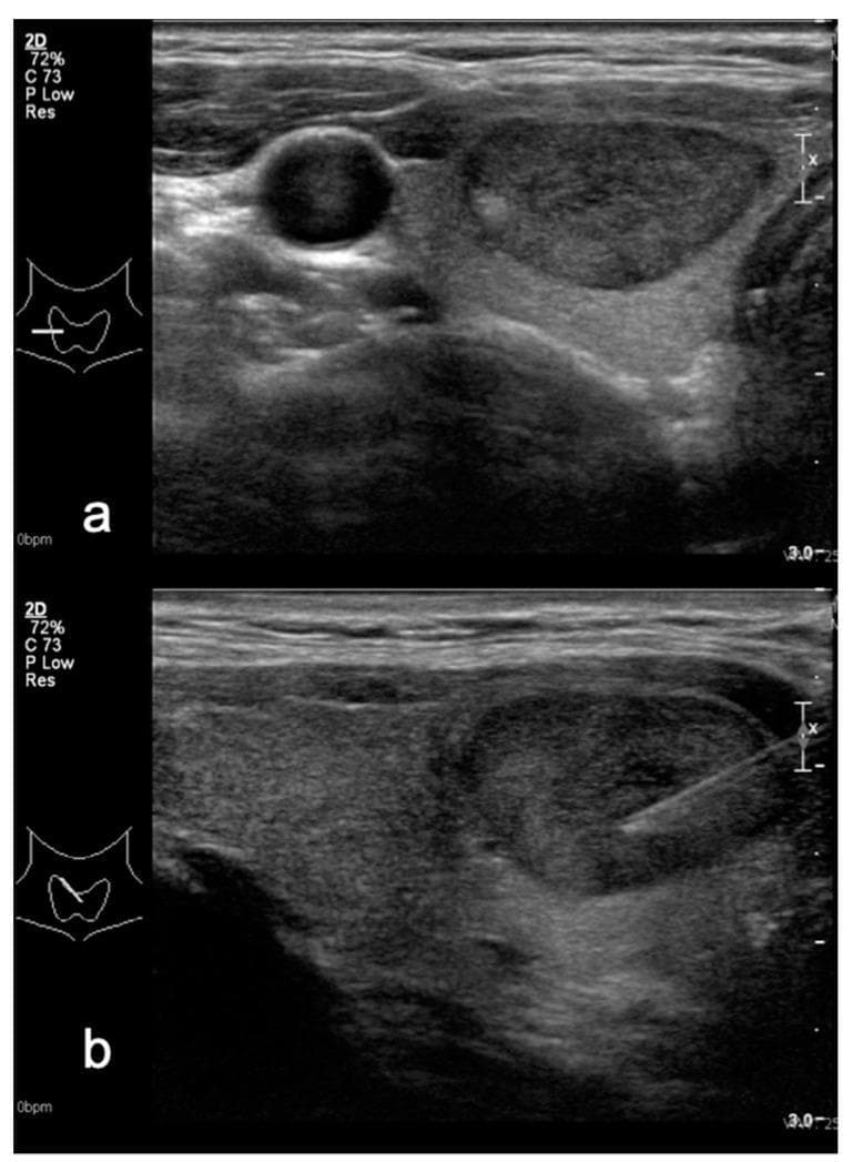 This diagnostic ultrasound image presents two views—transverse (a) and sagittal (b)—of a thyroid nodule, illustrating key features for TIRADS (Thyroid Imaging Reporting and Data System) risk stratification. In both planes, the nodule is characterized as mildly hypoechoic relative to the surrounding brighter (more echogenic) thyroid parenchyma. The nodule possesses a well-defined, ovoid-to-slightly-irregular shape without evidence of macrocalcifications. View (a) demonstrates the nodule's relationship to adjacent vascular structures, appearing as anechoic circular lumens. View (b) shows the nodule in its longitudinal axis, clearly depicting a biopsy needle positioned within the lesion, characteristic of a real-time ultrasound-guided fine needle aspiration (FNA) procedure. The image serves as an educational example of differentiating nodule echogenicity and performing diagnostic interventional procedures. Clinically, this nodule was classified as TIRADS 4A (Kwak system) and TIRADS 3 (M-TIRADS), with a subsequent Bethesda II cytology result indicating a benign process.