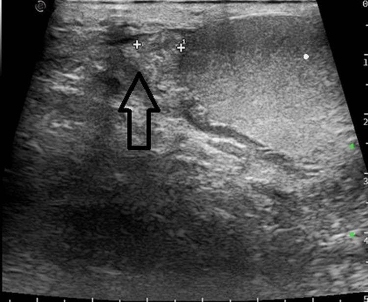 A grayscale diagnostic ultrasound image showing a sagittal view of the right scrotal contents. The image demonstrates the right testis and the right epididymis. The right testis (right side of the image) appears as an oval structure with a homogeneous, mid-level echotexture and a smooth, well-defined tunica albuginea. To the left of the testis, indicated by a black arrow, is the right epididymis. The epididymal head shows normal echogenicity, being slightly hyperechoic or isoechoic relative to the testicular parenchyma, with a characteristic granular echo pattern. Two calipers (+) are placed to measure the dimensions of the epididymal head. No evidence of hydrocele, epididymal enlargement, or abnormal focal lesions is observed in this view, supporting a finding of a normal right epididymis. This diagnostic image serves as a clinical reference for normal male reproductive anatomy and the evaluation of scrotal pathology such as epididymitis or torsion.
