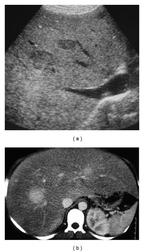 This composite educational image features abdominal diagnostic imaging of a 14-year-old patient with Glycogen Storage Disease (GSD) type I. Image (a) is a grayscale abdominal ultrasound demonstrating hepatomegaly and diffuse increased echogenicity of the liver parenchyma, characteristic of hepatic steatosis. Multiple well-demarcated, hypoechoic nodules are visible within the bright background of the fatty liver. Image (b) is an axial contrast-enhanced CT scan obtained during the arterial phase. It depicts the same enlarged, low-attenuation (steatotic) liver containing multiple solid nodules that exhibit intense hypervascular enhancement relative to the surrounding parenchyma. These findings are clinically diagnostic of hepatocellular adenomas (HCA) in the context of GSD. The image serves as a teaching tool for pediatric radiology, illustrating the imaging appearance of multiple adenomatosis and its typical association with metabolic storage disorders.