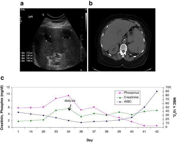 This composite educational image illustrates the clinical and laboratory findings of splenic infarction in a patient with Chronic Myeloid Leukemia (CML). Panel A is a grayscale abdominal ultrasound showing an enlarged spleen (splenomegaly) with multiple peripheral, wedge-shaped hypoechoic lesions consistent with splenic infarcts; calipers measure several zones between 1.58 cm and 3.21 cm. Panel B displays a non-enhanced axial CT scan of the upper abdomen, confirming the presence of multiple peripheral hypodense areas within the spleen, which correlate with the ultrasound findings of infarction. Panel C is a line graph correlating laboratory values over a 42-day period, showing the relationship between Phosphorus (mg/dL), Creatinine (mg/dL), and White Blood Cell (WBC) count. Notably, the graph demonstrates an extreme shift from hyperphosphatemia to severe hypophosphatemia (<0.5 mg/dL) as the WBC count rapidly increases, suggesting a high metabolic demand or 'tumor lysis-like' sequestration during a leukemic blast crisis. This visual set is used to teach the radiological presentation of vascular complications in hematologic malignancies and the interpretation of metabolic trends in aggressive leukemia.