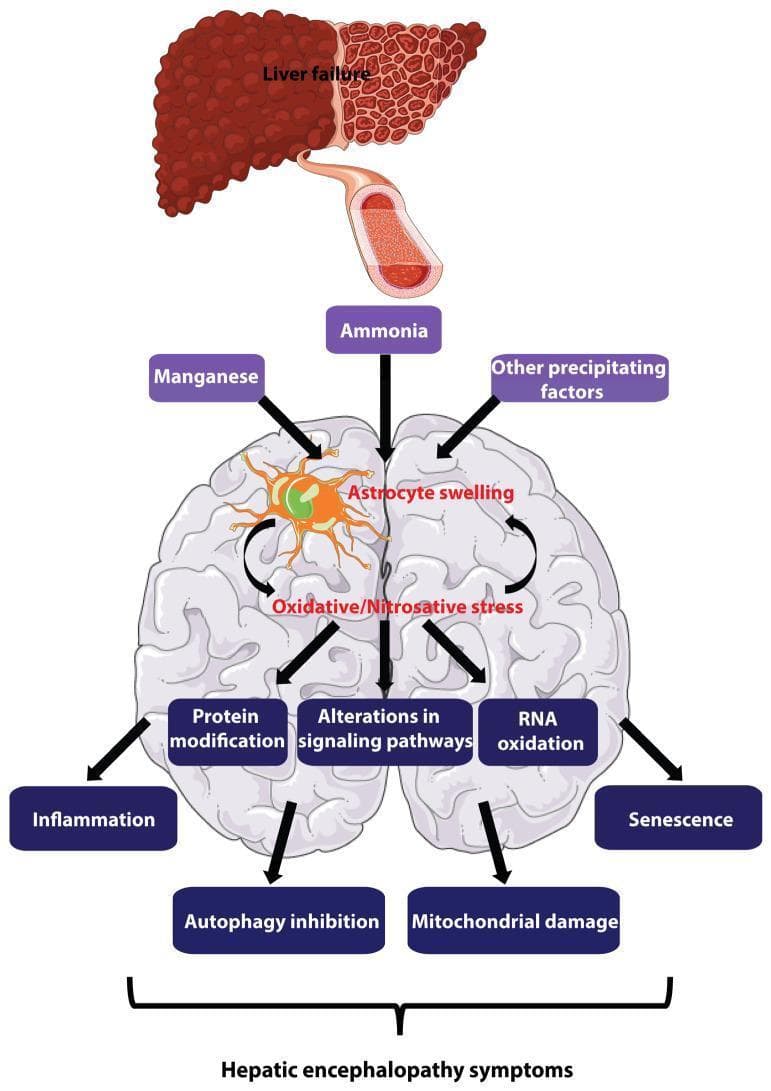 This pathophysiology diagram illustrates the major pathogenesis mechanisms of hepatic encephalopathy (HE). The flow begins with liver failure, shown as a cirrhotic liver, releasing metabolic toxins like ammonia and manganese into the systemic circulation via a blood vessel. These toxins, along with other precipitating factors, target the brain, specifically inducing astrocyte swelling. A central self-amplifying loop is depicted where astrocyte swelling and oxidative/nitrosative stress mutually reinforce each other. This cycle triggers a cascade of detrimental intracellular processes, including protein modification, RNA oxidation, and alterations in signaling pathways. Downstream effects featured include inflammation, autophagy inhibition, mitochondrial damage, and cellular senescence. These multi-factorial changes are linked via brackets to the ultimate manifestation of hepatic encephalopathy symptoms. The illustration uses a combination of anatomical representations (liver and brain) and text-based flow nodes to describe the transition from hepatic dysfunction to neurometabolic impairment, emphasizing the central role of astrocytes in the disease progression.
