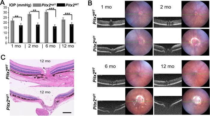 This composite educational resource illustrates an early-onset glaucoma phenotype in a mouse model (Pitx2egl1) compared to wild-type (Pitx2WT). Panel A contains a bar graph showing longitudinal intraocular pressure (IOP) data at 1, 2, 6, and 12 months. Pitx2egl1 mice exhibit significantly elevated IOP (peaking around 30 mmHg at 6 months) compared to the stable ~18 mmHg in controls. Panel B displays longitudinal diagnostic imaging, combining fundus photography and Optical Coherence Tomography (OCT). In mutants, fundus images reveal a characteristic partial white ring around the optic cup, while OCT B-scans demonstrate progressive optic nerve cupping and excavation starting as early as 2 months. Panel C presents H&E-stained histological sections of the optic nerve head at 12 months. The mutant section shows severe glaucomatous cupping (excavation) and thinning of the inner retinal layers, specifically the retinal nerve fiber layer (RNFL), compared to the healthy morphology of the wild-type. This visual summarizes the clinical signs of hypertensive glaucoma including elevated IOP, structural optic disc changes, and neurodegeneration.