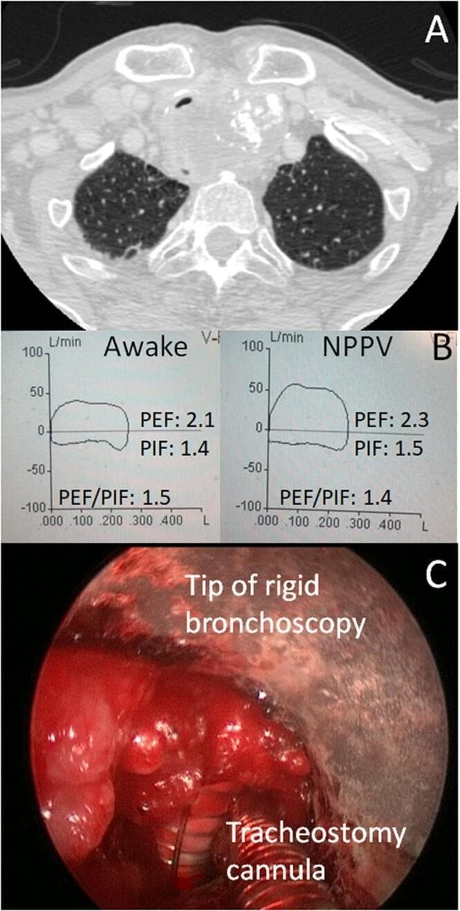 This composite educational image illustrates a case of extrinsic tracheal compression due to thyroid cancer and its subsequent management. Panel A is an axial CT scan of the upper chest showing a large, heterogeneous soft tissue mass anterior and lateral to the trachea, causing significant luminal narrowing and posterior displacement. Panel B presents Pulmonary Function Test (PFT) flow-volume loops comparing 'Awake' and 'Non-Invasive Positive Pressure Ventilation' (NPPV) states. The curves demonstrate a classic 'box' shape characteristic of fixed upper airway obstruction, with minimal change in Peak Expiratory Flow (PEF) and Peak Inspiratory Flow (PIF) despite positive pressure, indicating a firm, non-dynamic stenosis. Panel C is an intraoperative endoscopic photograph showing a rigid bronchoscopy-guided percutaneous dilatational tracheostomy (PDT). Visible landmarks include the tip of the rigid bronchoscope and a tracheostomy cannula positioned within an inflamed, stenotic tracheal lumen. This multi-modal presentation highlights the diagnostic pathway from radiological imaging and physiological assessment to surgical intervention for malignant airway obstruction.