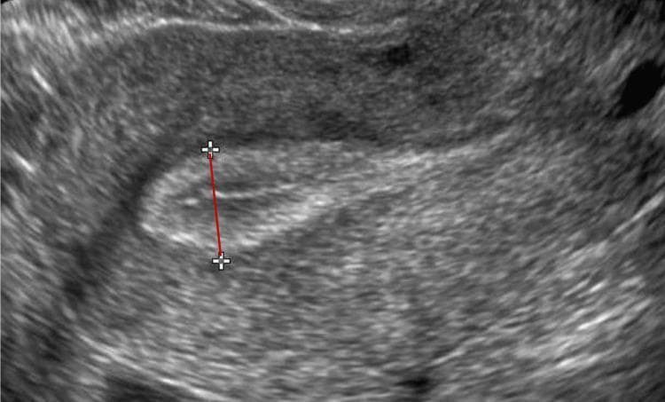 This diagnostic ultrasound image demonstrates a sagittal (longitudinal) cross-section of the uterus, focusing on the uterine cavity and the measurement of endometrial thickness (EMT). The endometrial lining appears as a relatively hypoechoic (darker) central region compared to the surrounding heterogeneous myometrium. The measurement technique is visually represented by a red electronic caliper line marked with '+' cursors at each end. This line extends perpendicular to the endometrial canal, from one stratum basalis interface to the opposite interface, marking the thickest portion of the functional endometrium. Such imaging is standard in reproductive medicine and gynecology to assess endometrial receptivity during assisted reproduction cycles (e.g., IVF or FET), where an EMT below 7 mm is typically categorized as a thin endometrium. The clear differentiation between the echogenic basalis layers and the hypoechoic endometrial canal is critical for accurate diagnostic measurement and clinical decision-making regarding embryo transfer feasibility.