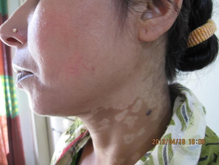 A clinical photograph of the face and neck of a patient from Bangladesh illustrating post-kala-azar dermal leishmaniasis (PKDL). The primary dermatological finding is a widespread, confluent macular rash characterized by hypopigmented to depigmented patches. These pale, irregularly shaped lesions are prominently visible across the cheek and extend inferiorly onto the neck. The lesions vary in size, with some smaller macules coalescing into larger, irregularly bordered areas. Additionally, a single, dark, well-demarcated circular nodule or papule is noted on the lateral aspect of the neck, situated within the hypopigmented region. This visual presentation represents the macular form of PKDL, which is a common cutaneous complication following visceral leishmaniasis (Kala-azar) in Southeast Asian populations. The image serves as a diagnostic reference for identifying characteristic pigmentary changes and distribution patterns of Leishmania donovani-induced skin disease.