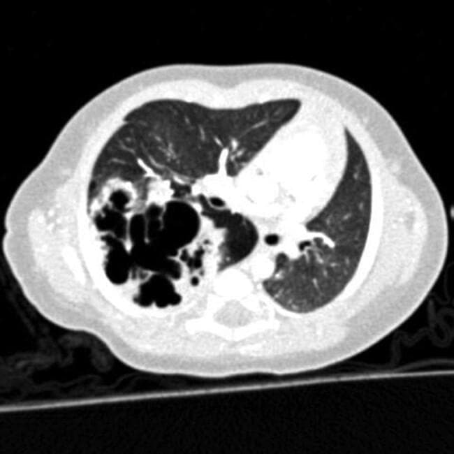 This transverse diagnostic computerized tomography (CT) scan of a pediatric thorax demonstrates a congenital pulmonary airway malformation (CPAM) within the right lung, likely involving the lower lobe. The hallmark feature is a large, multicystic mass consisting of various-sized, air-filled cystic spaces with an irregular 'honeycomb' internal architecture. These cysts are separated by thin septations and surrounded by areas of increased soft tissue density representing pulmonary consolidation or dysplastic parenchyma. The mass exerts a mild mass effect, characterized by the partial displacement of the mediastinum towards the contralateral side. In contrast, the left lung parenchyma appears relatively normal with preserved aeration, visible vascular markings, and no evidence of cystic lesions or structural abnormalities. The image is a classic representation of pediatric thoracic pathology used to teach the radiological presentation of congenital lung malformations, focusing on the differentiation of cystic lung lesions and their impact on adjacent thoracic structures.