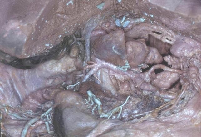 This clinical photograph shows a detailed anatomical dissection of the human stomach's lymphatic system in a cadaveric specimen. The image highlights the complex network of gastric lymph nodes and their associated vessels without the use of standard injections like cedar oil, though some blue-green vital dye staining is visible on specific lymphatic structures to aid visualization. The central anatomy includes the lesser curvature and retroperitoneal space, showing fleshy, tan-to-pinkish-brown visceral organs interspersed with numerous lymph nodes of varying sizes. Significant branching of mesenteric and gastric blood vessels is observed, with lymphatic channels following the vascular supply. The spatial organization demonstrates the high density of the lymphatic network near the left gastric, hepatic, and splenic drainage areas, which is clinically significant for understanding the pathways of gastric cancer metastasis. The textures are glistening and moist, typical of a surgical or high-fidelity cadaveric dissection, illustrating the intimate relationship between the lymphatic vessels and the surrounding adipose and connective tissues.