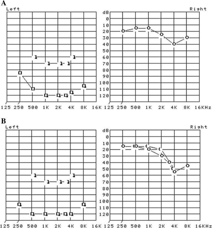This Comparison Chart displays two sets of pure tone audiometry results (A and B) representing initial diagnosis and a one-year follow-up for a patient. Each set contains separate audiograms for the left and right ears. The x-axis represents frequency in Hertz (Hz) from 125 Hz to 16 kHz, and the y-axis represents hearing threshold in decibels (dB) from 0 to 120. In both panels A and B, the right ear audiogram shows mild hearing loss, with thresholds mostly between 10 and 40 dB, showing a slight dip at 4 kHz. In contrast, the left ear audiogram demonstrates profound sensorineural hearing loss. In initial panel A, left ear thresholds are recorded at or below 80 dB, reaching 120 dB at frequencies between 1 kHz and 4 kHz. Follow-up panel B shows that the profound hearing loss in the left ear persists, with thresholds remaining largely in the 100-120 dB range across all tested frequencies. This visual comparison illustrates a clinical case of permanent unilateral profound sensorineural hearing loss.