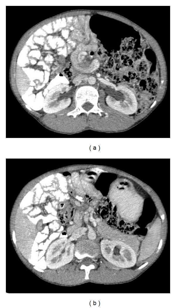 Two axial postcontrast CT images of the abdomen demonstrate findings consistent with midgut malrotation and volvulus. Image (a) reveals the characteristic 'whirl sign,' where the duodenum and a dilated superior mesenteric vein (SMV) wrap in a clockwise direction around the axis of the superior mesenteric artery (SMA). Image (b) shows a reversal of the normal mesenteric vascular anatomy, with the SMV located to the left of the SMA rather than its typical right-sided position. Additional findings include the displacement of jejunal loops to the right side of the abdominal cavity. These radiographic features are hallmark indicators of intestinal malrotation, commonly used in pediatric and emergency radiology to diagnose volvulus and associated mesenteric vascular torsion.