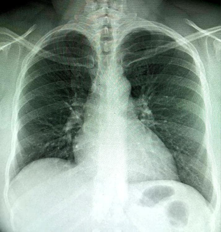 This diagnostic image is a frontal (posteroanterior) chest radiograph. The primary finding is a moderate enlargement of the cardiac silhouette, consistent with cardiomegaly, characterized by a cardiothoracic ratio of approximately 0.60. The lung fields show a diffuse accentuation of the bronchovascular pattern, appearing as branching linear densities radiating from the hila. This increased interstitial marking is most pronounced at the right lung base. Both costophrenic angles appear relatively sharp, and there is no evidence of discrete pulmonary consolidation, large pleural effusions, or pneumothorax. The mediastinal contours are intact, and the visualized bony structures including the ribs and clavicles appear unremarkable. This radiograph is an educational example used to demonstrate findings of early congestive heart failure or chronic pulmonary congestion, highlighting the visual assessment of the heart-to-thorax ratio and the distribution of pulmonary vascular markings.