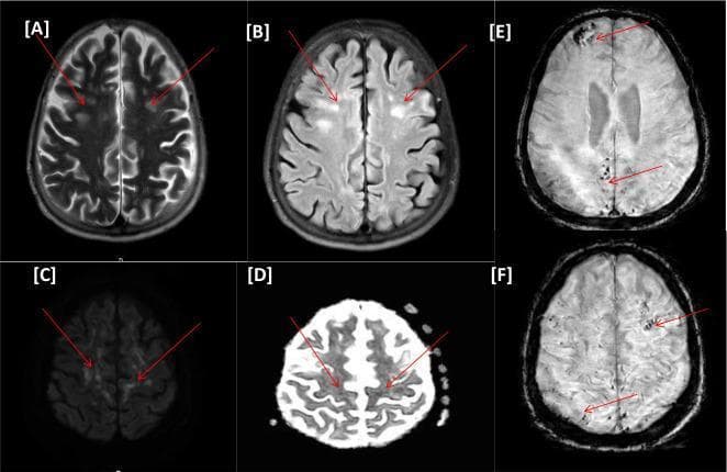 This diagnostic image set consists of six axial brain MRI sequences (A-F) from a clinical case of COVID-19-related encephalopathy. Images A (T2-weighted) and B (FLAIR) demonstrate bilateral, multifocal, hyperintense nodular and punctate lesions within the periventricular and subcortical white matter. Images C (DWI) and D (ADC map) reveal corresponding areas of diffusion restriction, highlighted by red arrows, indicating acute ischemic changes. Images E and F (Susceptibility-Weighted Imaging, SWI) show multiple punctate hypointense foci scattered across the frontal and posterior brain parenchyma, characteristic of susceptibility artifacts from microhemorrhagic changes or microbleeds. This combination of multifocal white matter hyperintensities, restricted diffusion, and microhemorrhages in a COVID-19 patient is highly suggestive of critical illness-associated cerebral microbleeds and leukoencephalopathy. The imaging highlights the neurological complications involving both vascular ischemia and microvascular hemorrhage within the brain parenchyma.