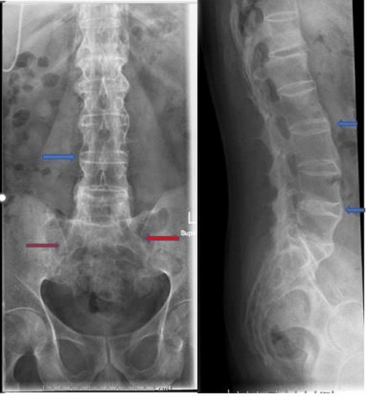 This diagnostic imaging shows anteroposterior (AP) and lateral X-ray views of the lumbar spine and pelvis, demonstrating classic radiographic hallmarks of advanced ankylosing spondylitis. The lumbar spine exhibits 'bamboo spine' morphology, characterized by the ossification of the annulus fibrosus and the formation of syndesmophytes. These vertical bony bridges connect adjacent vertebral bodies (highlighted by blue arrows), resulting in a continuous, straightened, and fused vertebral column with significant loss of normal intervertebral disc space. In the pelvic region, the sacroiliac (SI) joints show evidence of bilateral ankylosis (indicated by red arrows), with complete obliteration of the joint spaces, subchondral sclerosis, and bony fusion. These findings are clinically significant as they represent the end-stage structural damage typical of axial spondyloarthritis, leading to spinal rigidity and decreased mobility. The image serves as a definitive educational example of progressive inflammatory arthritis affecting the axial skeleton.