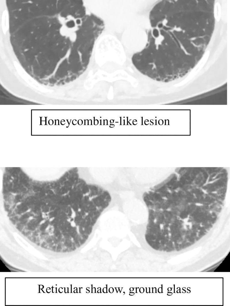 This diagnostic image consists of two axial high-resolution computed tomography (HRCT) scans of the human chest, demonstrating various patterns of interstitial lung abnormalities (ILAs). The upper panel displays a 'honeycombing-like lesion' characterized by clustered, cystic airspaces with thick, well-defined walls, primarily located in the subpleural and peripheral regions of the lower lung lobes. The lower panel illustrates 'reticular shadows' and 'ground-glass opacities.' The reticular pattern is visible as a fine network of linear opacities, while the ground-glass opacities present as a hazy increase in lung density that does not obscure the underlying bronchovascular structures. These findings are significant in the context of chronic obstructive pulmonary disease (COPD) and the progression of interstitial fibrosis. The imaging serves as a clinical reference for distinguishing specific radiological morphologies in pulmonology and radiology, specifically focusing on the diagnostic criteria for identifying early or comorbid interstitial changes in chronic lung disease patients.
