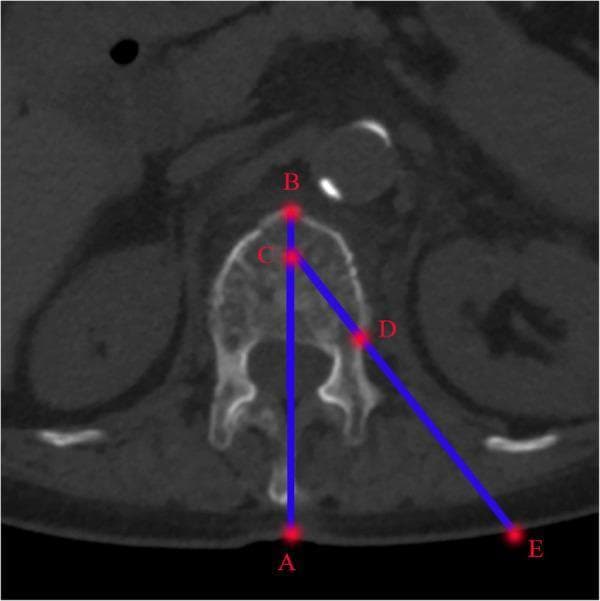 This diagnostic image is an axial CT scan of the lumbar spine used for preoperative planning of a percutaneous vertebral procedure, such as vertebroplasty or kyphoplasty. The scan shows a cross-section of a vertebra, including the vertebral body, pedicles, and spinous process, with surrounding soft tissue landmarks like the kidneys visible. Overlaid blue lines and red points (A-E) illustrate the geometry for a transpedicular approach. Line AB represents the anatomical midline of the vertebra. Point C is positioned at the anterior one-third of the vertebral body on the midline, while Point D marks the target entry site at the superolateral junction of the pedicle. Line CE extends from the target point C through the pedicle entry point D to the skin surface at Point E. The angle formed between midline AB and the trajectory line CE defines the required puncture angle for needle insertion. The distance between the skin entry point (E) and the spinous process midline (A) is mapped to guide the surgical incision location. This diagram serves as a clinical algorithm for determining precise instrumentation pathways relative to spinal anatomy.