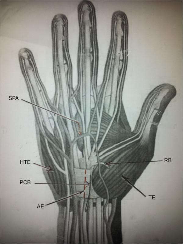 Anatomical diagram of the palmar hand and wrist highlighting key neurovascular and muscular landmarks relevant to carpal tunnel surgery. The illustration depicts the Thenar Eminence (TE) on the radial side and the Hypothenar Eminence (HTE) on the ulnar side. Centrally, the Transverse Carpal Ligament (Flexor Retinaculum) is shown with a red dashed line indicating a proposed surgical incision over an avascular area (AE) that is free of muscle attachments. The neurovascular structures include the Superficial Palmar Arch (SPA) located distally across the metacarpals, the Recurrent Branch (RB) of the median nerve curving into the thenar muscles, and the Palmar Cutaneous Branch (PCB) of the median nerve situated proximally near the wrist crease. This diagram serves as a clinical guide for understanding the spatial relationships between surgical incision sites and vital structures to avoid iatrogenic injury during hand procedures.