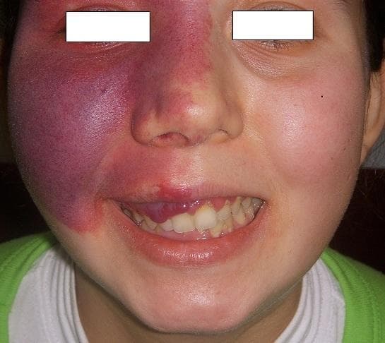 This clinical photograph displays a large, unilateral capillary malformation, commonly known as a port-wine stain (nevus flammeus), on the right side of a patient's face. The lesion is characterized by a deep purple to violaceous hue, with areas of lighter red towards the midline. Its distribution follows the V1 (ophthalmic) and V2 (maxillary) branches of the trigeminal nerve, covering the forehead, periorbital region, right nasal ala, and cheek. The lesion appears congestive and lacks sharply defined borders, blending into the surrounding skin. Additionally, the image shows intraoral manifestations: significant gingival hyperplasia is visible on the right side of the maxillary arch, appearing as bright red, bulbous overgrowths of the gingival tissue. The combination of a facial port-wine stain in the V1/V2 distribution and ipsilateral gingival vascular involvement is a classic clinical presentation of Sturge-Weber syndrome (encephalotrigeminal angiomatosis). This visual is essential for identifying vascular phakomatoses and understanding their dermatological and oral surgical implications.