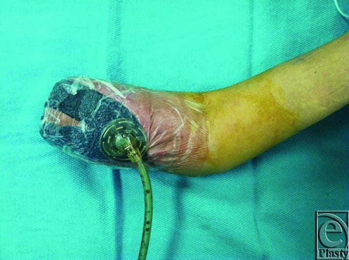A clinical photograph of an upper extremity following a transradial mid-forearm amputation. The residual limb is shown with a vacuum-assisted closure (VAC) system in place. The distal end of the stump is covered with a black, porous polyurethane foam dressing, which is secured and airtight under a transparent adhesive drape. A circular suction port is positioned on the lateral aspect of the stump, with a translucent tube containing trace amounts of serosanguinous fluid extending from it. The skin proximal to the transparent dressing exhibits a color gradient: there is a zone of erythematous, reddish-pink inflammation immediately adjacent to the dressing, transitioning into a yellowish-tan hue, and finally returning to a standard skin tone near the elbow. This image demonstrates the management of a complex surgical site, specifically for cases of pyoderma gangrenosum where optimized immunosuppression and negative pressure wound therapy are utilized to promote healing and prevent further tissue necrosis.