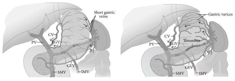 This medical illustration consists of two side-by-side comparison diagrams depicting the pathophysiology of sinistral (left-sided) portal hypertension due to splenic vein thrombosis. The diagrams show the hepatobiliary and gastrointestinal venous anatomy, including the liver, stomach, spleen, and pancreas. The left diagram represents normal venous anatomy where the splenic vein (SV), portal vein (PV), superior mesenteric vein (SMV), and inferior mesenteric vein (IMV) are patent with physiological blood flow. The right diagram illustrates the effects of a thrombus within the splenic vein. This obstruction leads to retrograde flow and increased pressure in the collateral venous pathways, specifically causing the development of prominent gastric varices, dilatation of the short gastric veins, coronary vein (CV), and gastroepiploic vein (GEV). Notably, in both the normal and pathological states, the portal vein, SMV, and IMV remain patent, highlighting that the hypertension is localized to the splenic drainage system. Arrows indicate the direction of venous blood flow, shifting toward the gastric wall in the presence of the thrombus.