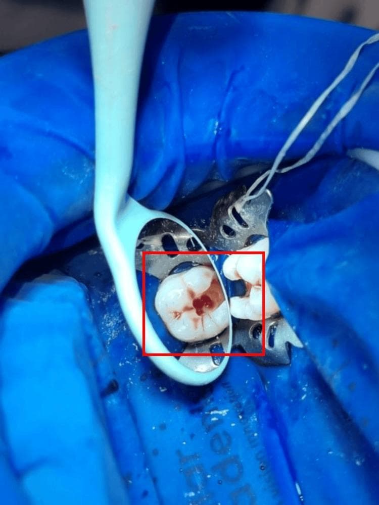 This clinical photograph displays a procedural step in restorative dentistry or endodontics, focusing on a lower left first molar following carious dentin removal and access cavity preparation. The tooth is isolated using a blue rubber dam held by a metallic dental dam clamp. The occlusal surface of the molar shows a prepared cavity with distinct reddish-brown discoloration within the dentin structure, typical of chronic carious lesions or pulpal involvement, while the surrounding enamel remains intact and whitish. A dental mirror is positioned to provide an indirect view of the distal and occlusal aspects of the preparation. Adjacent to the tooth, a metallic matrix band is visible, indicating preparation for a proximal restoration. This image serves as an educational tool for demonstrating pulp chamber de-roofing, caries excavation, and the necessity of proper field isolation using a rubber dam for aseptic dental procedures.