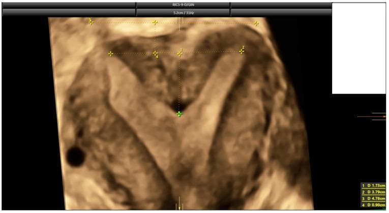 This diagnostic image is a 3D coronal ultrasound reconstruction of a human uterus, specifically highlighting a congenital uterine anomaly. The visual demonstrates a septate uterus, characterized by a prominent internal fundal indentation that divides the superior portion of the uterine cavity into two sections. Visible electronic calipers and numbered annotations (1–4) mark critical anatomical measurements used for classification according to ESHRE-ESGE and ASRM criteria. Measurement 1 (1.73 cm) indicates the depth of the fundal indentation, while Measurement 4 (0.90 cm) assesses the uterine wall thickness, resulting in a high indentation-to-wall-thickness (I:WT) ratio of 192%. The external fundal contour remains relatively flat or convex, a key feature distinguishing the septate uterus from a bicornuate uterus. This educational visual is used in reproductive medicine and radiology to teach the standardized assessment of Müllerian duct anomalies, focusing on the differentiation between septate, subseptate, and arcuate uterine morphologies through quantitative morphometric analysis.