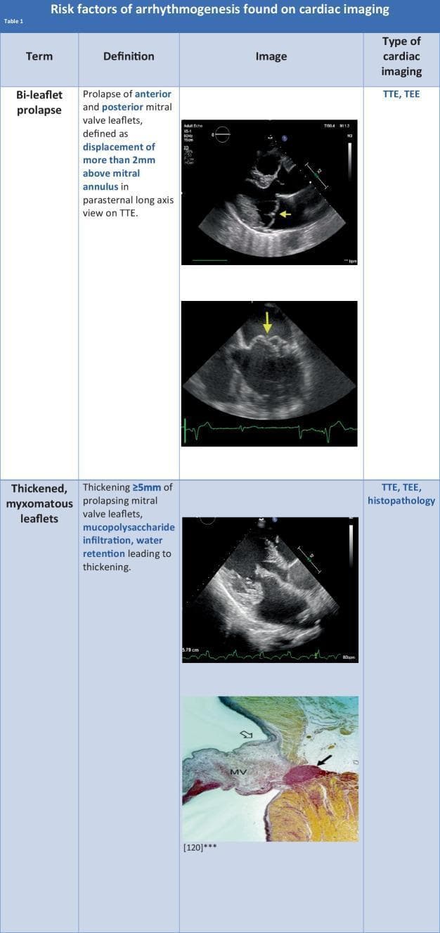 A comparison chart titled 'Risk factors of arrhythmogenesis found on cardiac imaging' illustrating diagnostic features of Mitral Valve Prolapse (MVP). The content is organized into categories covering bi-leaflet prolapse and thickened, myxomatous leaflets. For bi-leaflet prolapse, transthoracic echocardiogram (TTE) images in the parasternal long-axis view demonstrate the displacement of both anterior and posterior leaflets more than 2mm above the mitral annulus (indicated by yellow arrows). For thickened, myxomatous leaflets, the chart includes a TTE image showing mitral valve thickening of 5mm or more, alongside a histopathology slide (labeled MV) demonstrating mucopolysaccharide infiltration and structural expansion of the valve leaflet tissue. The visual material serves as a diagnostic guide for cardiologists and medical students to identify arrhythmogenic substrates in MVP using echocardiography and histopathological correlation. Key modalities mentioned include TTE, TEE (transesophageal echocardiography), and histopathology.